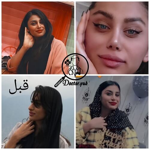 تصویر قبل و بعد از عمل بینی، با مشاوره تیم دکی یاب ♥ 10 تا از بهترین دکترهای جراح بینی در شیراز
