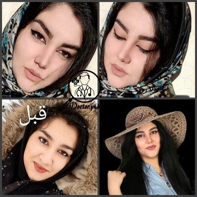 تصویر قبل و بعد عمل بینی، با مشاوره تیم دکی یاب ♥ 10 تا از بهترین دکترهای جراح بینی در شیراز
