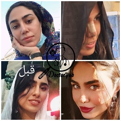 جراحی بینی اقساطی شیراز