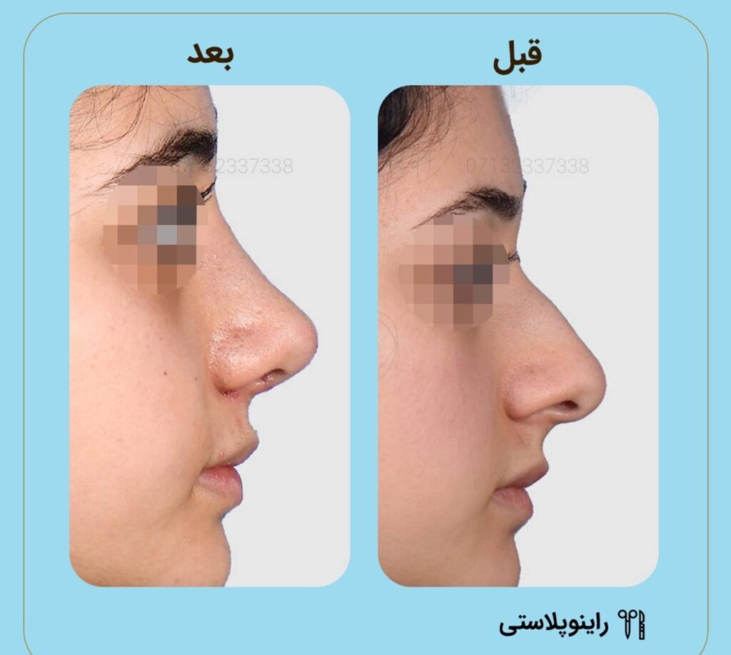 نمونه عمل بهترین جراح بینی شیراز