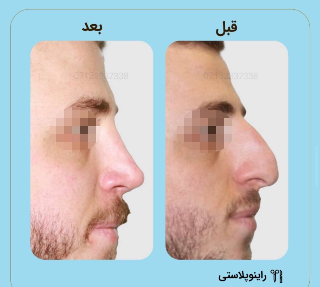 نمونه جراحی بهترین دکتر عمل بینی در شیراز
