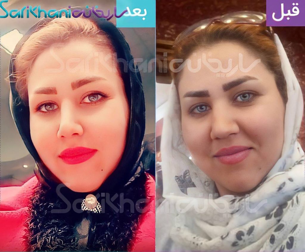 عمل بینی با دکتر داریوش ساریخانی جراح بینی شیراز