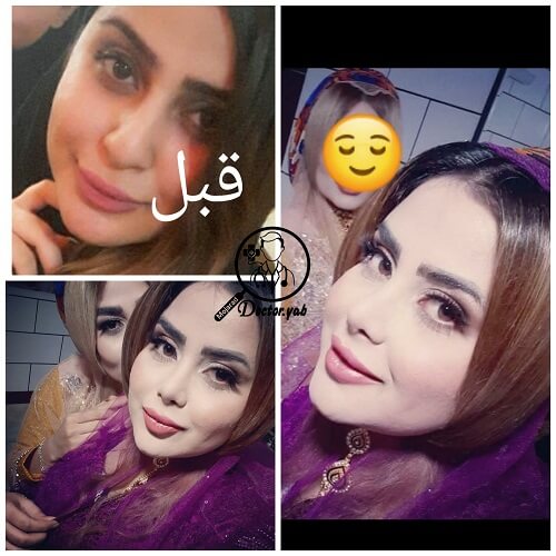 پنج ماه پس از عمل بینی، با مشاوره تیم دکی یاب در معرفی بهترین جراح بینی شیراز برای چهره و بینی فرد