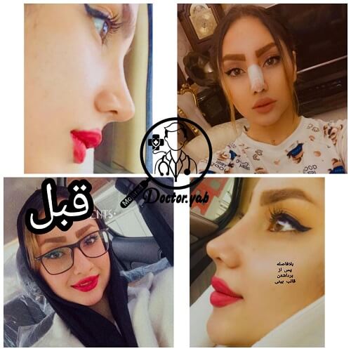 تصویر قبل و بعد عمل بینی، با مشاوره تیم دکی یاب ♥ 10 تا از بهترین دکترهای جراح بینی در شیراز 