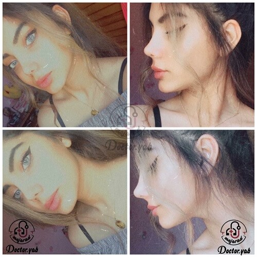 نتیجه جراحی مراجعه کننده به تیم دکی یاب ❤️ بهترین جراح بینی شیراز