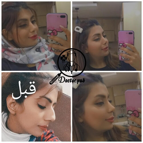 به تصویر بالا توجه کنید 👆 شش ماه پس از عمل، با مشاوره تیم دکی یاب در معرفی بهترین جراح بینی شیراز برای چهره و بینی فرد