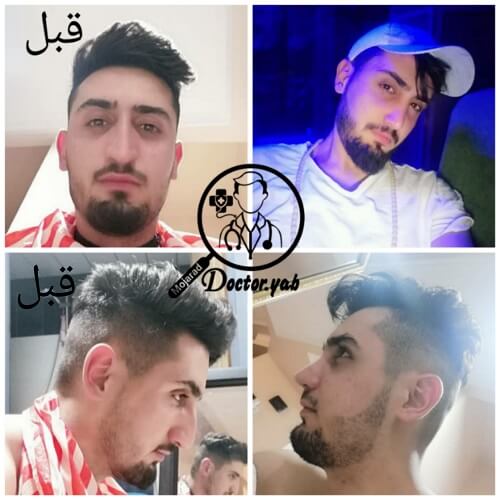 تصویر قبل و بعد مراجعه کننده عزیز ما، پنج ماه پس از عمل بینی، با مشاوره تیم دکی یاب در معرفی بهترین جراح بینی شیراز برای چهره و بینی فرد