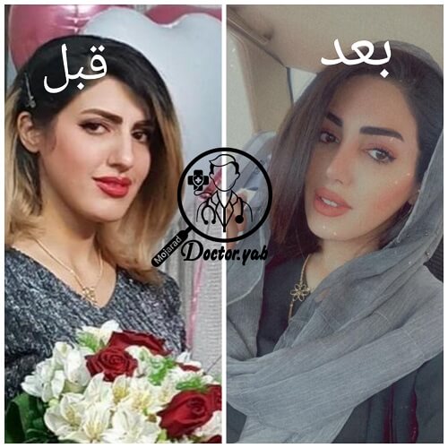 تصویر قبل و بعد از عمل بینی، با مشاوره تیم دکی یاب ♥ 10 تا از بهترین دکترهای جراح بینی در شیراز
