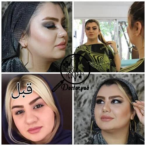 عمل بینی با مشاوره دکی یاب؛ جراح بینی در مازندران