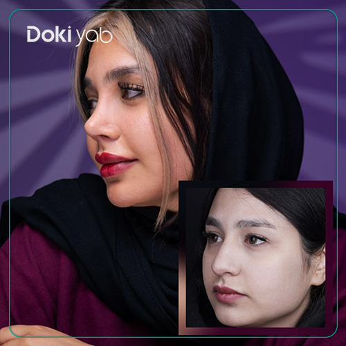 نمونه عمل بینی با جراح خوب با مشاوره دکی یاب