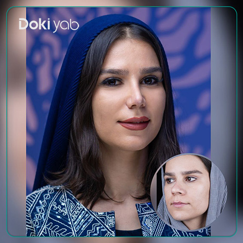 نمونه کار جراحی بینی با بهترین جراحان در دکی یاب