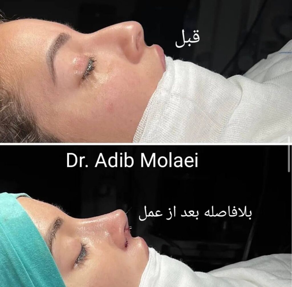 نمونه تصویر جراحی بینی دکتر ادیب ملائی