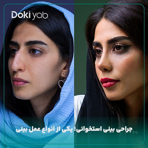 نمونه جراحی بینی استخوانی با مشاوره دکی یاب؛ مقاله انواع عمل بینی
