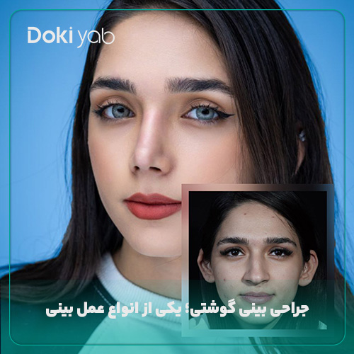 عمل بینی گوشتی؛ نمونه جراحی بینی با دکی یاب