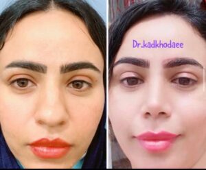 دکتر عمل زیبایی بینی در شیراز
