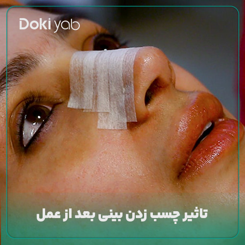  تاثیر چسب زدن بینی بعد از عمل
