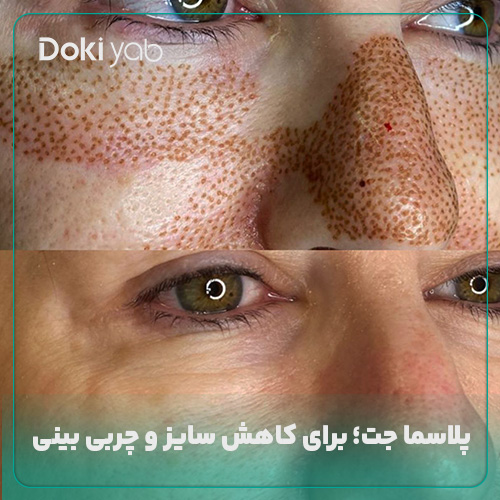 پلاسما جت روشی برای کاهش سایز و چربی بینی