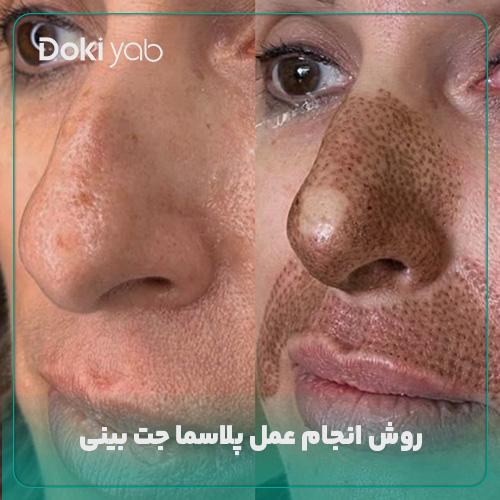 روش انجام عمل پلاسما جت بینی