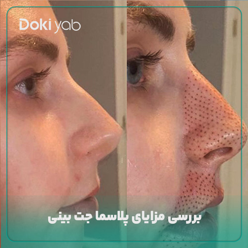 بررسی مزایای پلاسما جت بینی