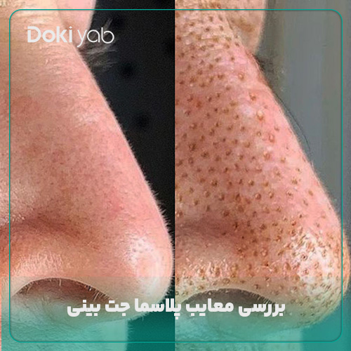 بررسی معایب پلاسما جت بینی