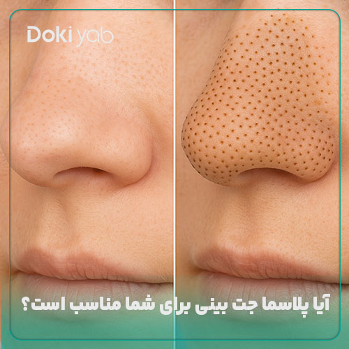 بررسی اینکه پلاسما جت بینی برای چه کسانی مناسب است