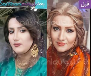 عمل بینی با دکتر داریوش ساریخانی جراح بینی شیراز
