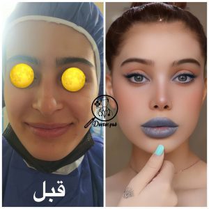نمونه عمل جراحی بینی دکتر حمید رضا کاظمی، دکتر عمل بینی در شیراز