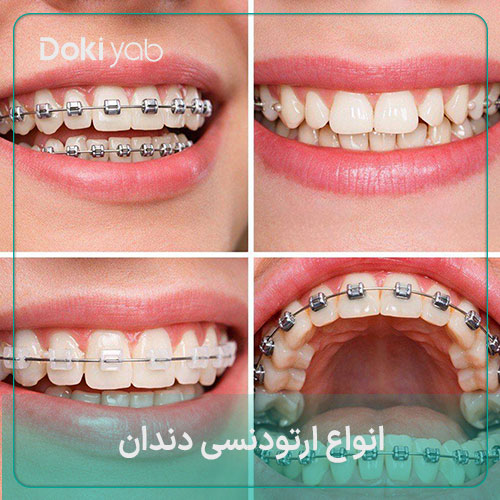 انواع ارتودنسی دندان در شیراز