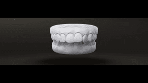 عکس مشکل اوربیت در ارتودنسی دندان