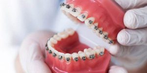 هزینه ارتودنسی دندان در شیراز