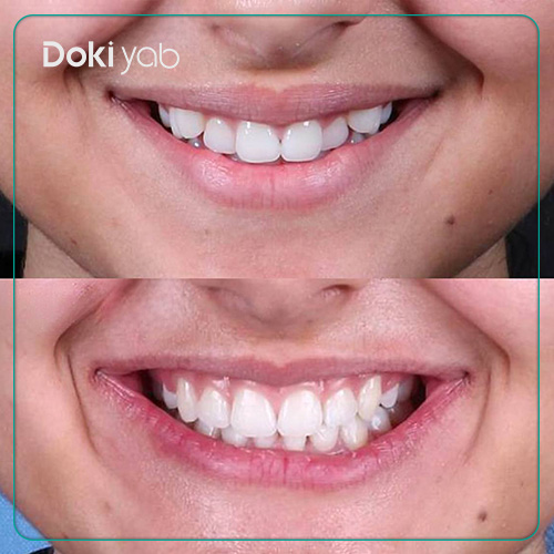 نمونه کار ارتودنسی دندان توسط دکتر شیوا ترابی در شیراز