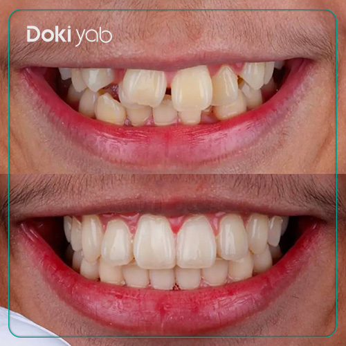 تصویر قبل و بعد از ارتودنسی با دکتر قهرمانی در شیراز در مجموعه دکی یاب