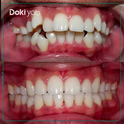 نمونه کار ارتودنسی با دکتر قهرمانی در شیراز در مجموعه دکی یاب