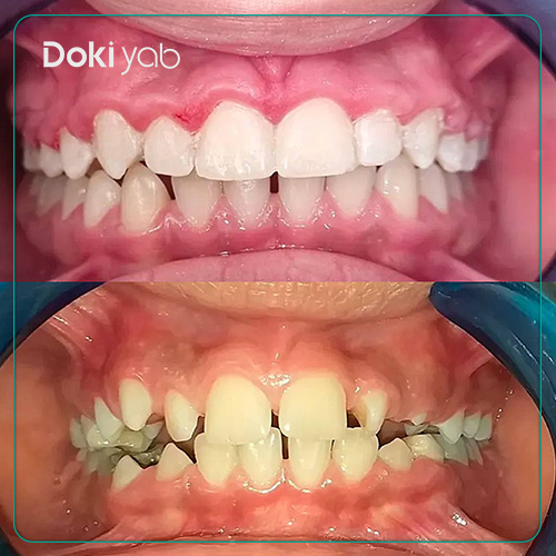 نمونه ارتودنسی دندان توسط دکتر محسن تهمتن در شیراز