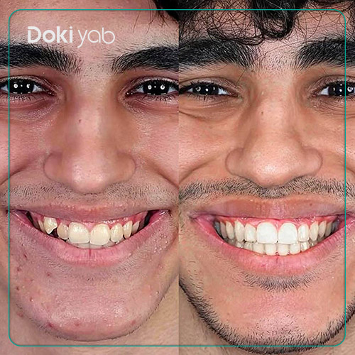 نمونه کار ارتودنسی دندان توسط دکتر فرزانه خواجه در شیراز