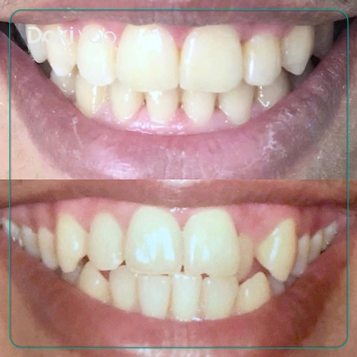 نمونه کار ارتودنسی دکتر شیما رستمی دکتر ارتودنسی در شیراز