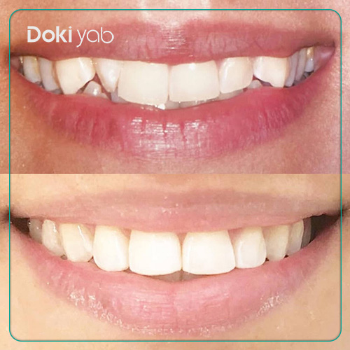 نمونه کار ارتودنسی دکتر شیما رستمی دکتر ارتودنسی کودکان در شیراز