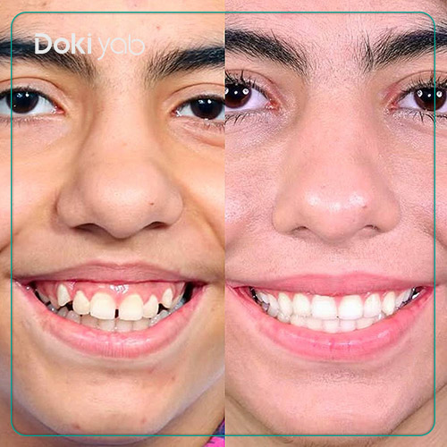 نمونه کار ارتودنسی دکتر فرزانه خواجه در شیراز