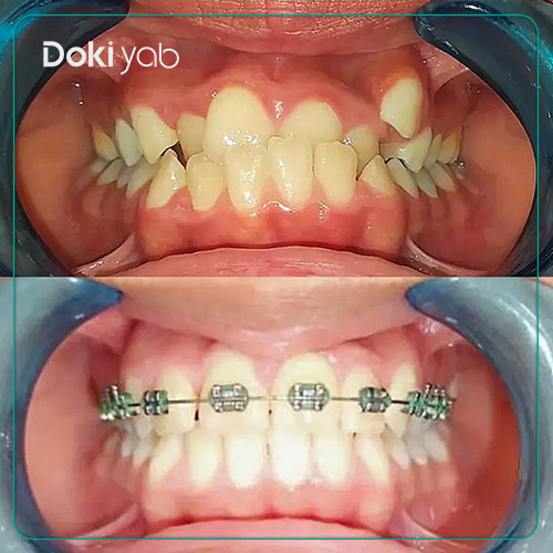 نمونه کار ارتودنسی دکتر محسن تهمتن در شیراز