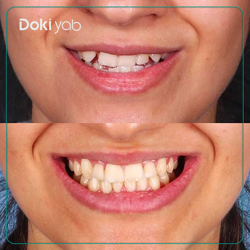 نمونه کار ارتودنسی دکتر شیوا ترابی در شیراز