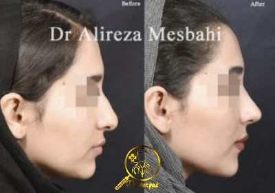 نمونه کار دکتر علیرضا مصباحی جراح زیبایی بینی در شیراز