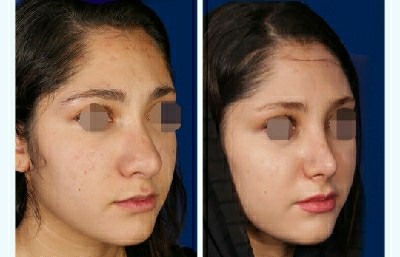نمونه عمل بینی دکتر محسن روشنی جراح بینی شیراز