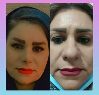 نمونه کار دکتر امید زرگرانی جراح بینی شیراز