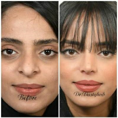 نمونه عمل دکتر حسن دستغیب جراح زیبایی بینی در شیراز