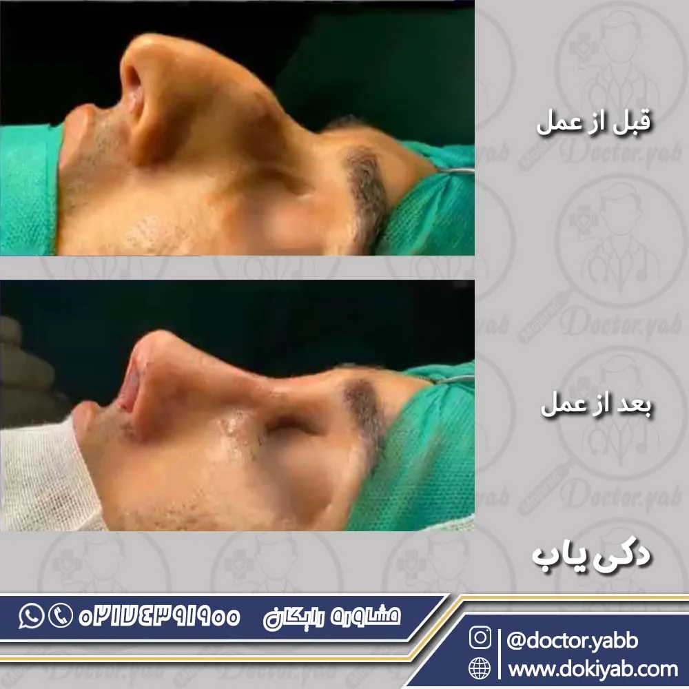 جراحی بینی در شیراز؛ نمونه کار دکتر حسین مرادیان