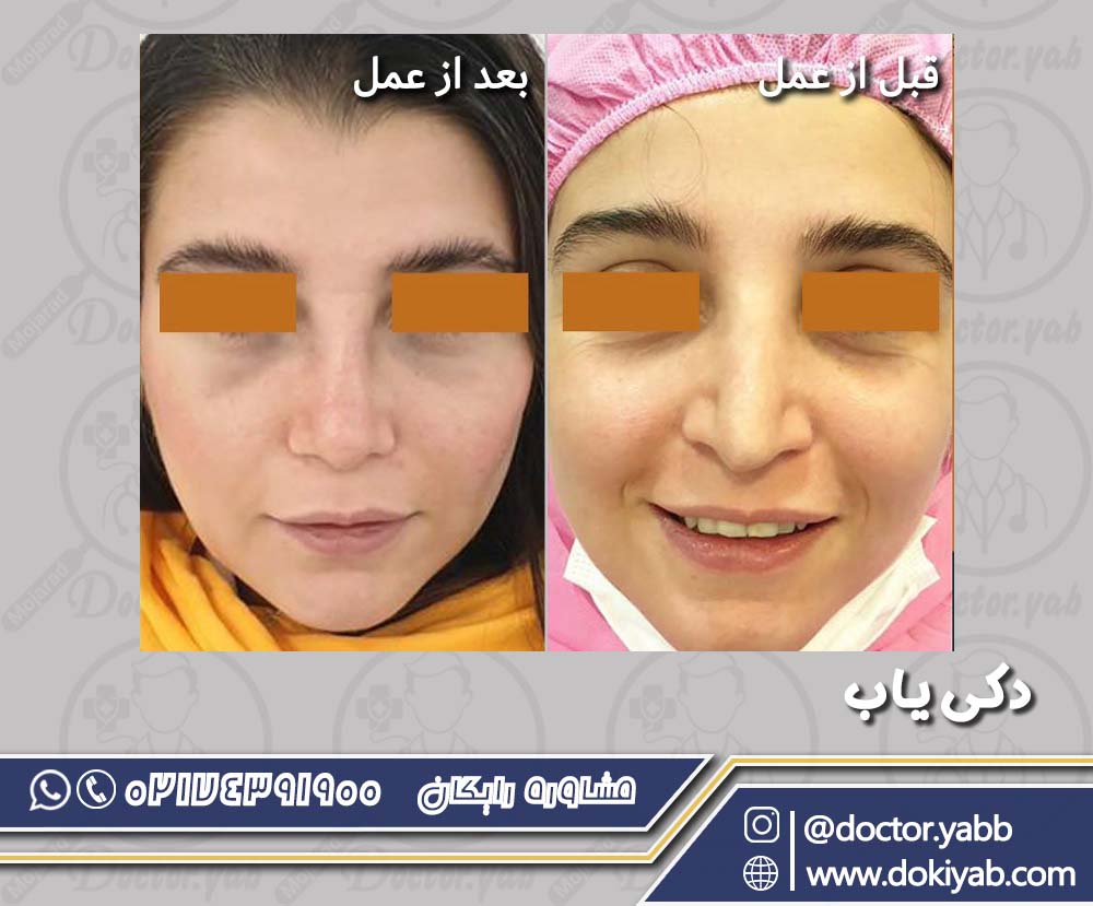 عمل زیبایی بینی در شیراز؛ دکتر بهروز گندمی