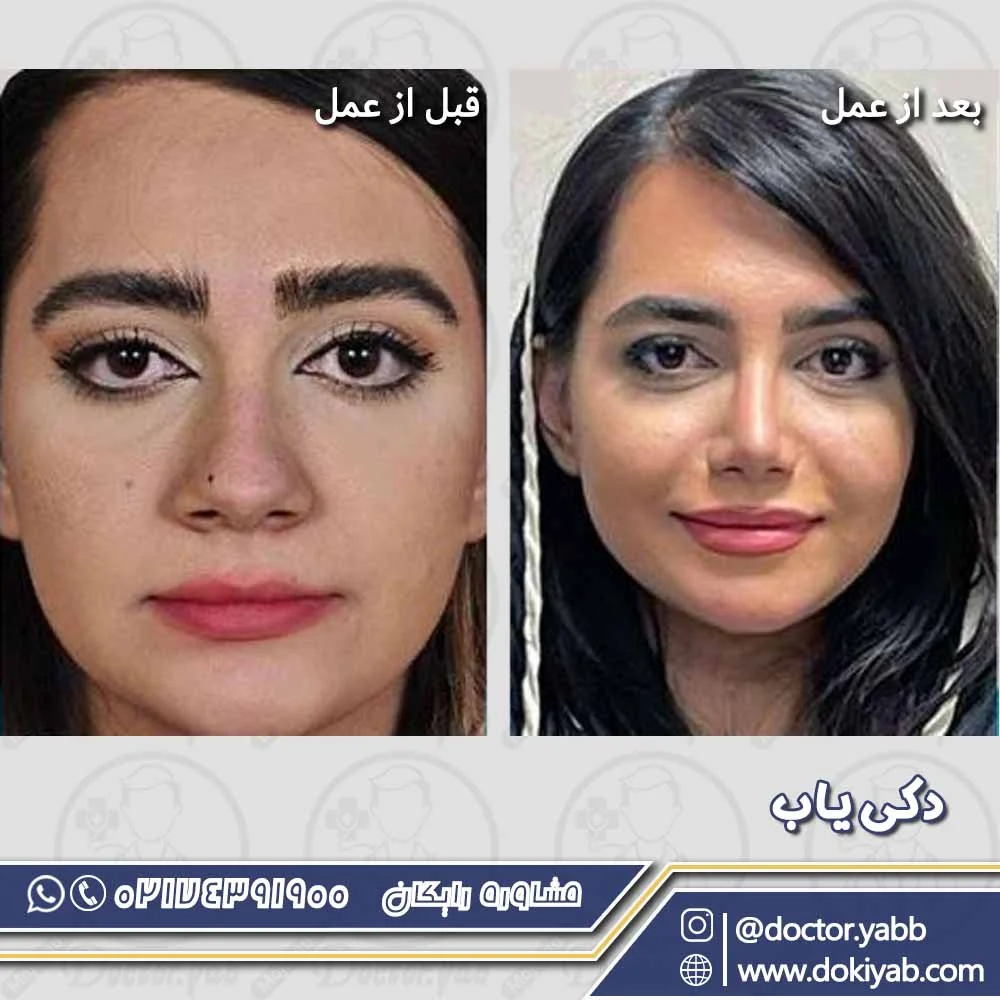 نمونه جراحی بیین فانتزی با دکتر سلمان شاکری