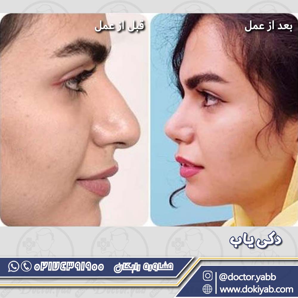 قبل و بعد ازعمل بینی؛ دکتر سلمان شاکری