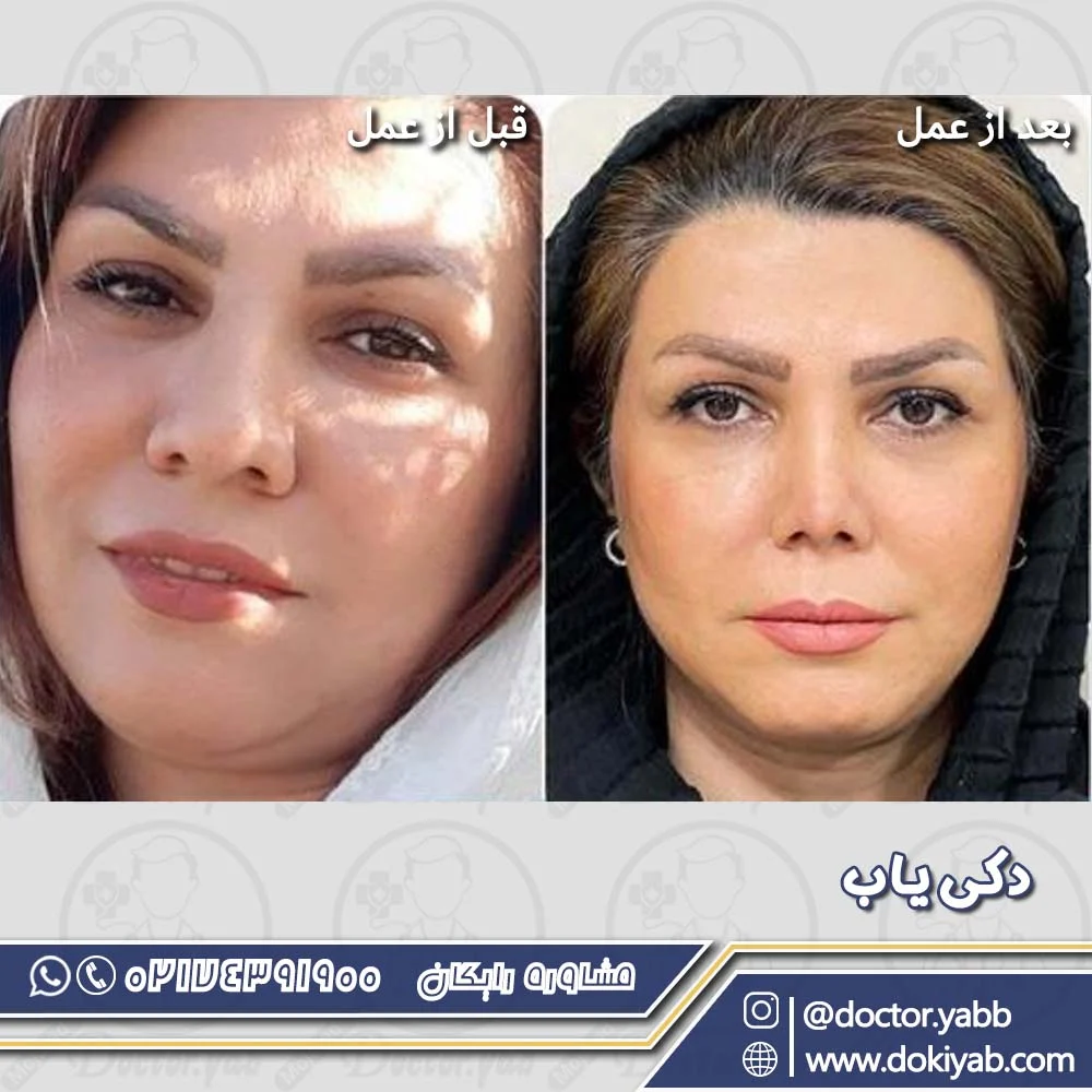 نمونه جراحی بینی با دکتر سلمان شاکری