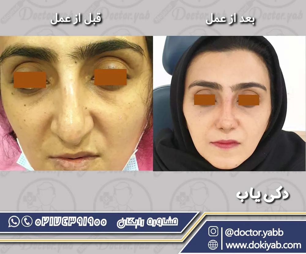 نمونه جراحی بینی دکتر بهروز گندمی